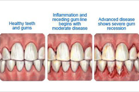 teeth disease stages