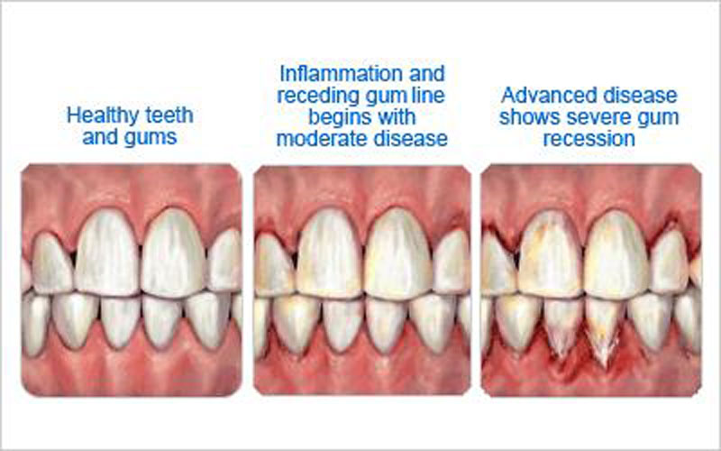 teeth disease stages