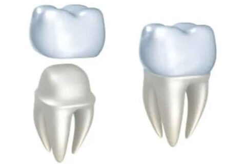 Zirconia Crown Placement