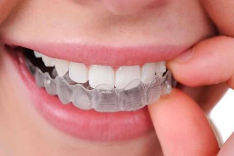 Clear Aligner Braces