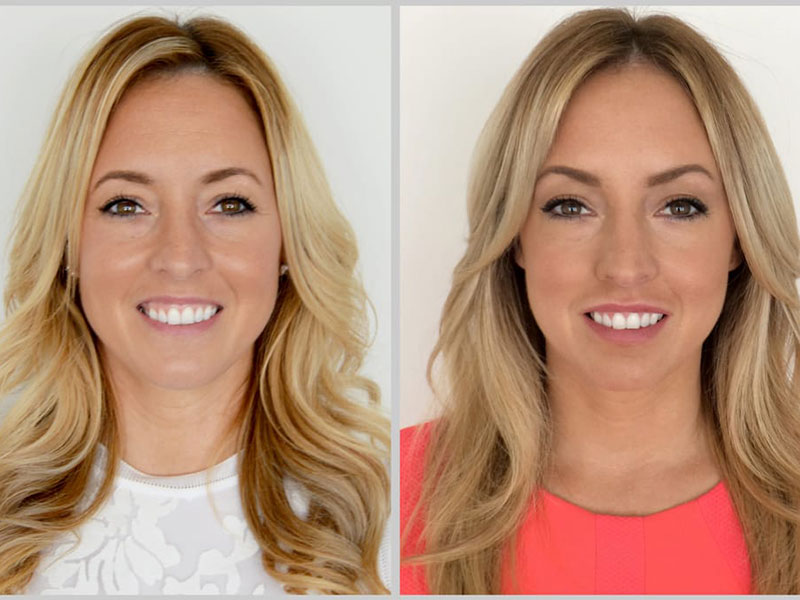 Gummy smile before and after