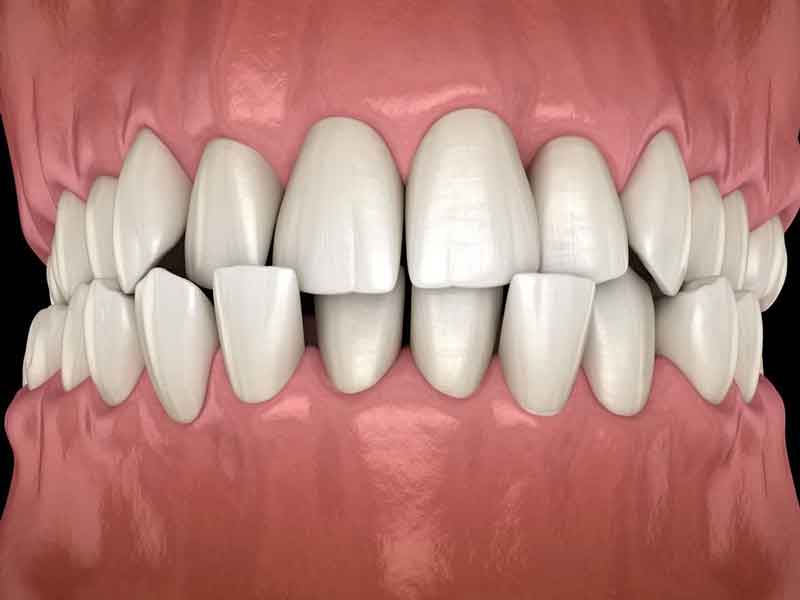 Teeth Structure