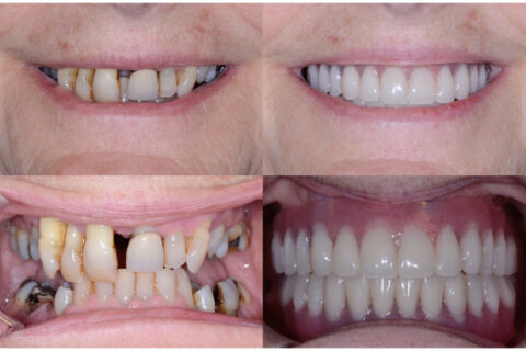 Hybrid Denture
