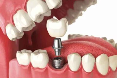 Dental Implants