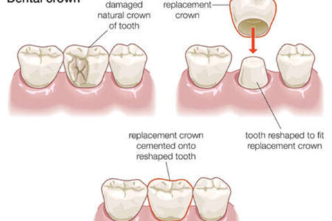 Dental Crown