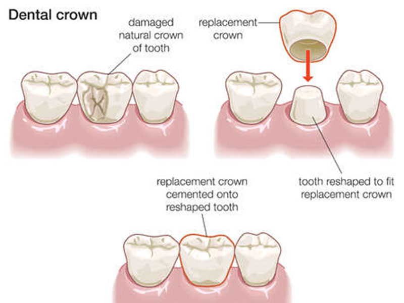 Dental Crown