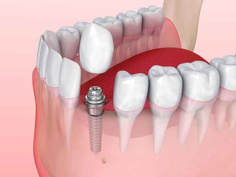 Fixing a broken tooth