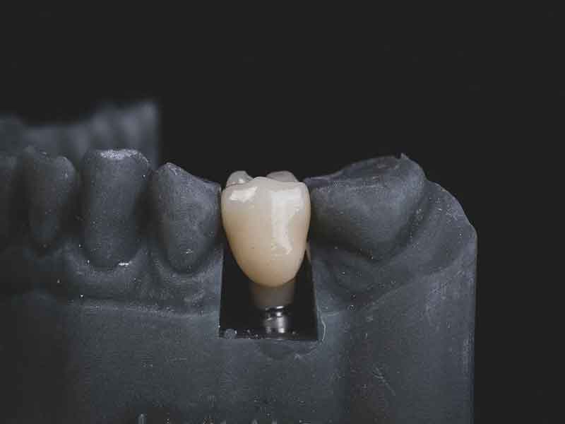 Veneers