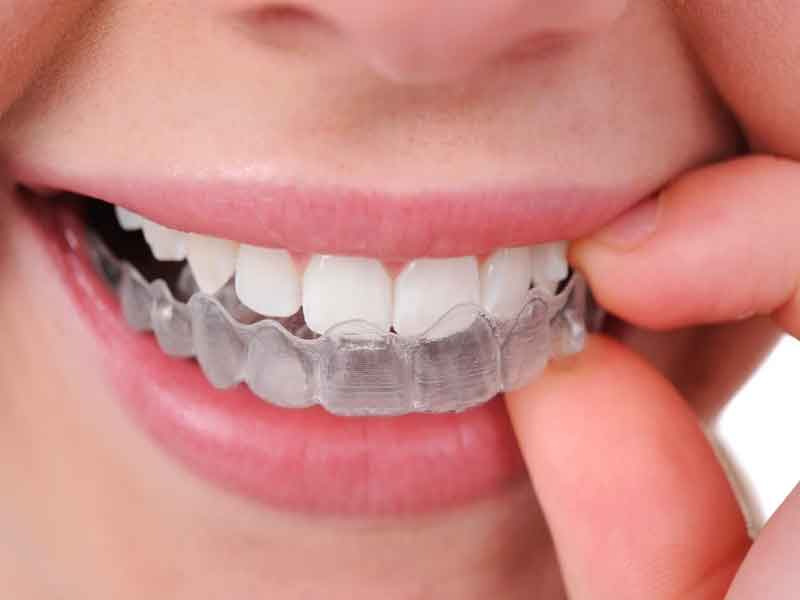 Smile Direct Club