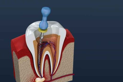 Root Canals Unveiled