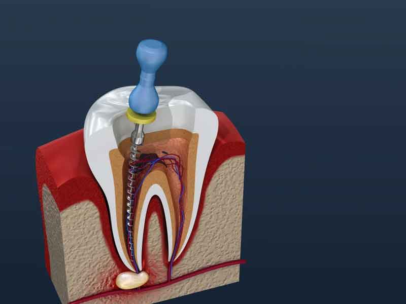 Root Canals Unveiled