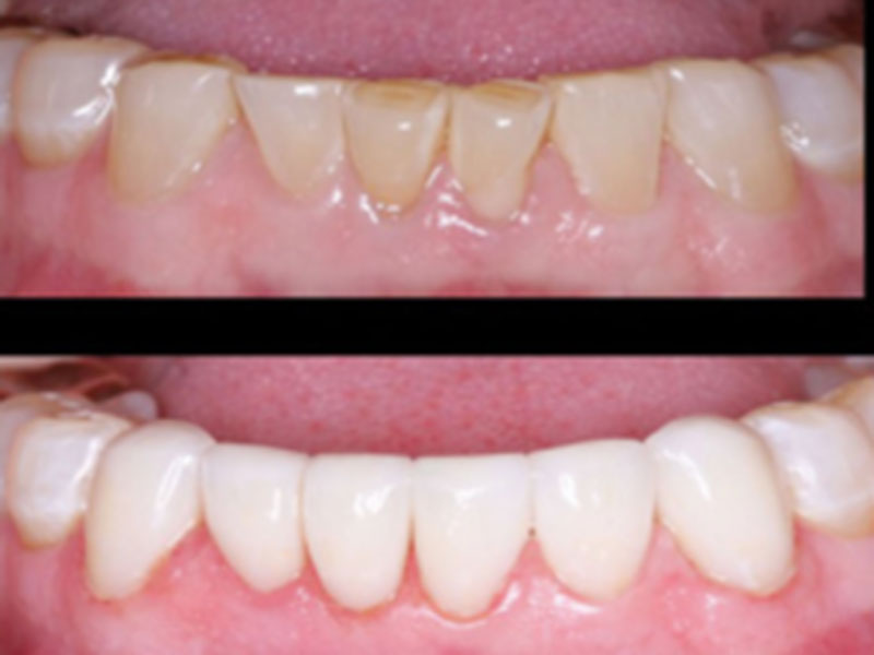 Dental Crowns